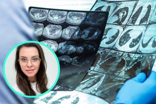 Pacjenci mają udar i o tym nie wiedzą? Neurolog: To bardzo popularny błąd